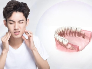 Răng khôn mọc lệch gây đau đầu – Mối liên hệ ít ai ngờ tới