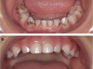 TRẺ EM BAO NHIÊU TUỔI CÓ THỂ ĐẾN CẠO VÔI RĂNG