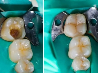 SÂU RĂNG KHÔNG CÒN LÀ NỔI ÁM ẢNH: GIẢI PHÁP TỐI ƯU DÀNH CHO BẠN