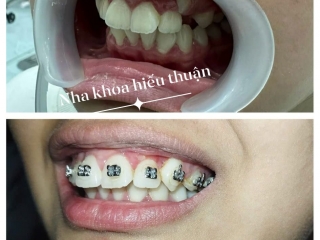 CHỈNH NHA TẠI NHA KHOA HIẾU THUẬN