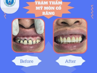 TRÁM RĂNG TẠI NHA KHOA HIẾU THUẬN 