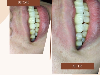 Đính Hạt Xoàn Răng – Điểm Nhấn Tinh Tế Cho Nụ Cười Tỏa Sáng