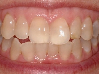 Răng nhiễm màu kháng sinh – Có tẩy trắng được không?