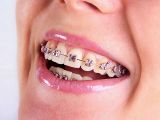 Niềng răng thẩm mỹ - Giải pháp chỉnh nha an toàn, hiệu quả lâu dài, tự tin nụ cười mỗi ngày