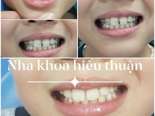 KHÁM VÀ ĐIỀU TRỊ BỆNH LÝ RĂNG MIỆNG TỪ SỚM – GIẢI PHÁP BẢO VỆ SỨC KHỎE RĂNG MIỆNG TOÀN DIỆN
