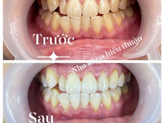 Chăm sóc răng miệng trẻ em – đầu tư sức khỏe tương lai